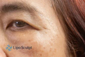 Cryopen: The Revolutionary Treatment for Age Spots Unveiled 2 Are age spots Radlett giving you low self esteem? Contact us today!