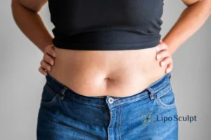 Bidding Farewell to Muffin Tops with Aqualyx Fat Injections 2 Do you wish you could reduce your muffin top Radlett With Aqualy fat dissolving injections you can!