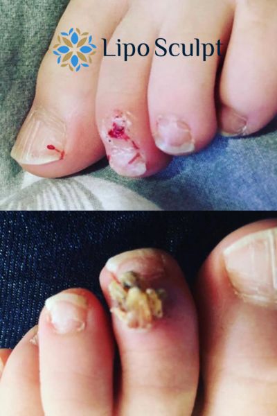 Wart removal customer results from Lipo Sculpt Radlett